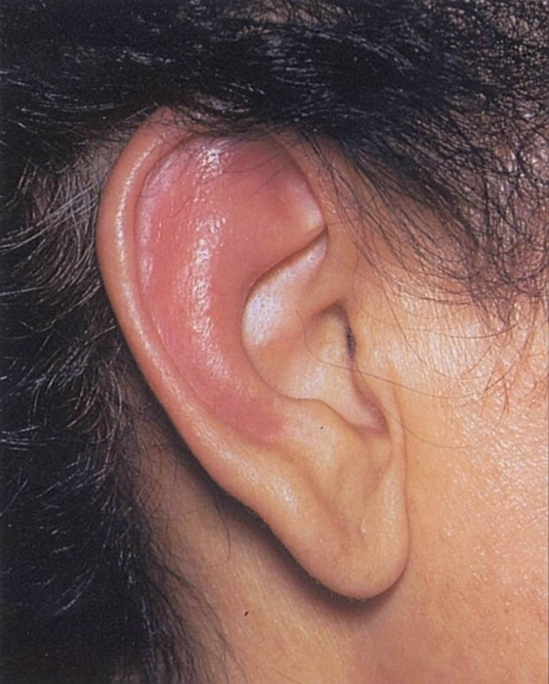 Polychondrite en rechute (oreille)