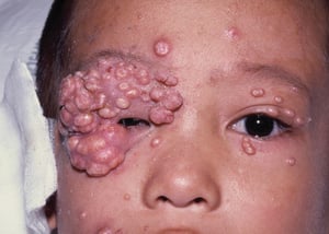 Mollusco contagioso in un bambino con infezione da HIV