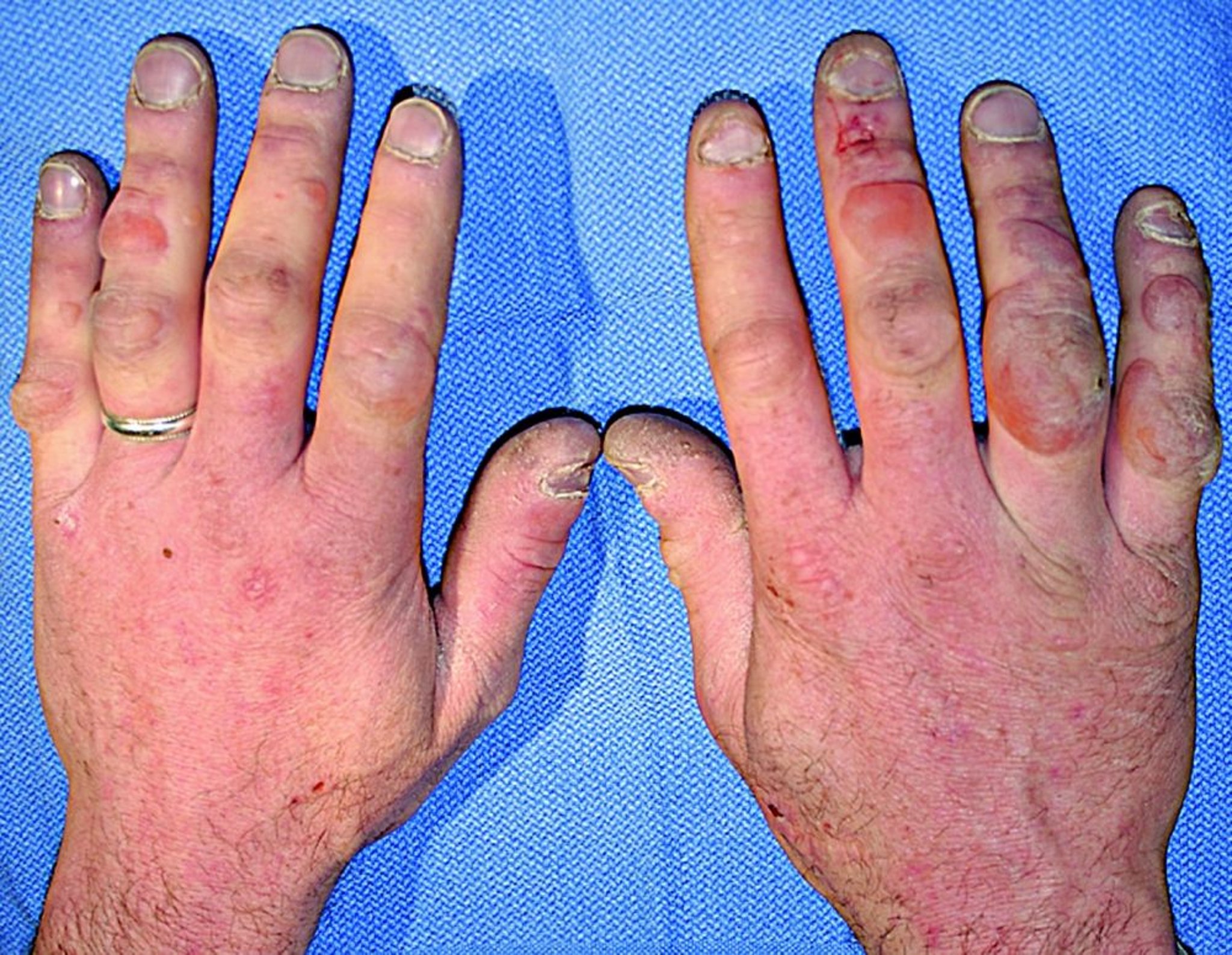 Тяжелое обморожение рук