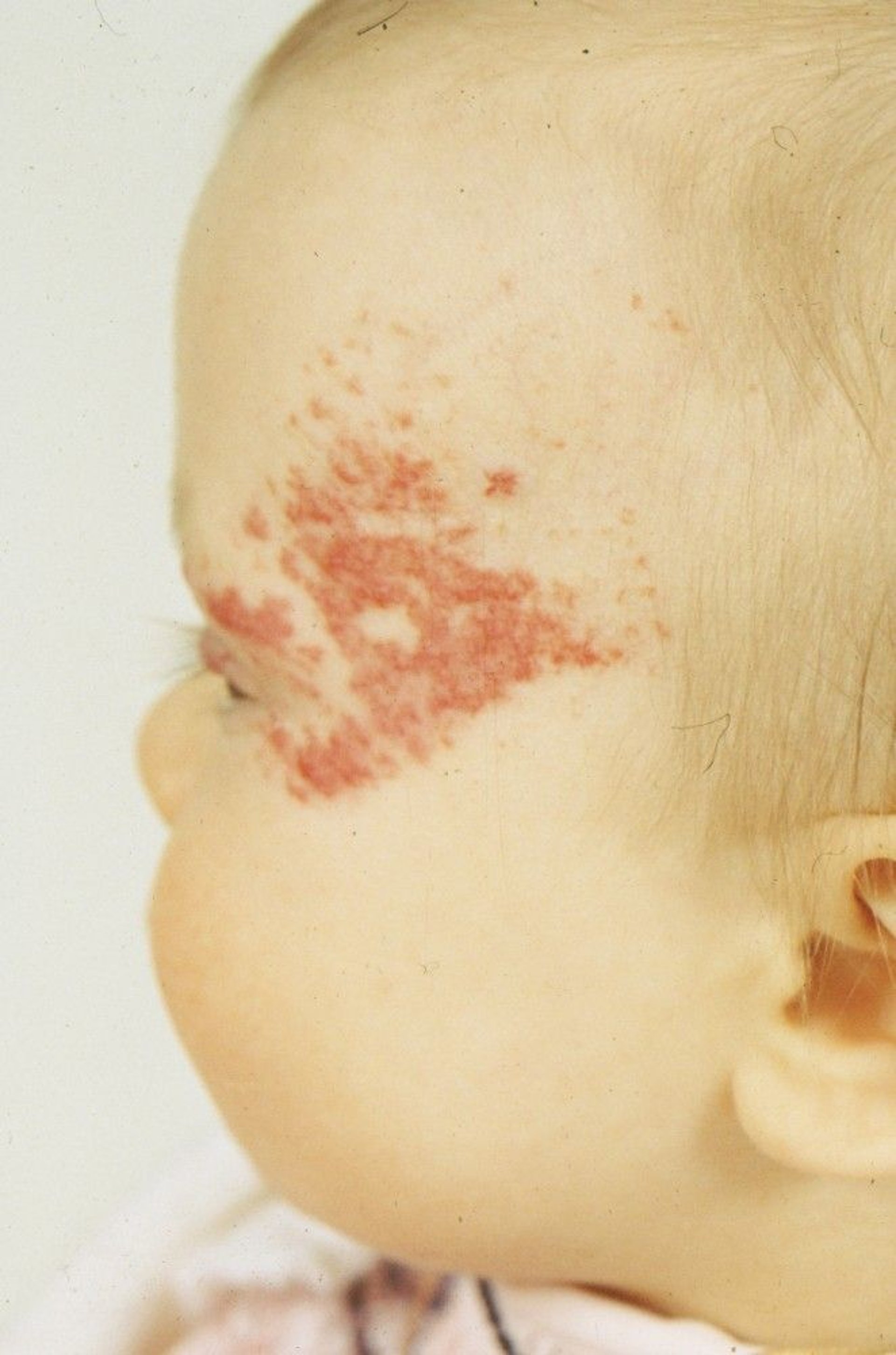 Hemangioma ya Stroberi