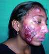 Acne conglobata sul viso