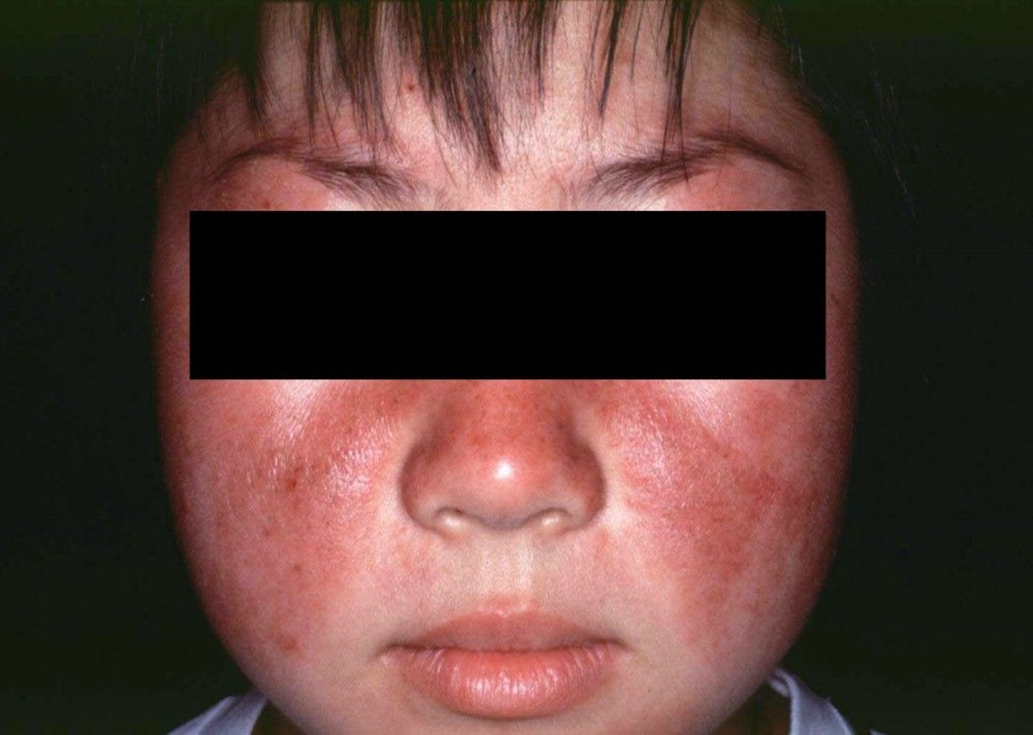 Systemic Lupus Erythematosus (Butterfly Rash)