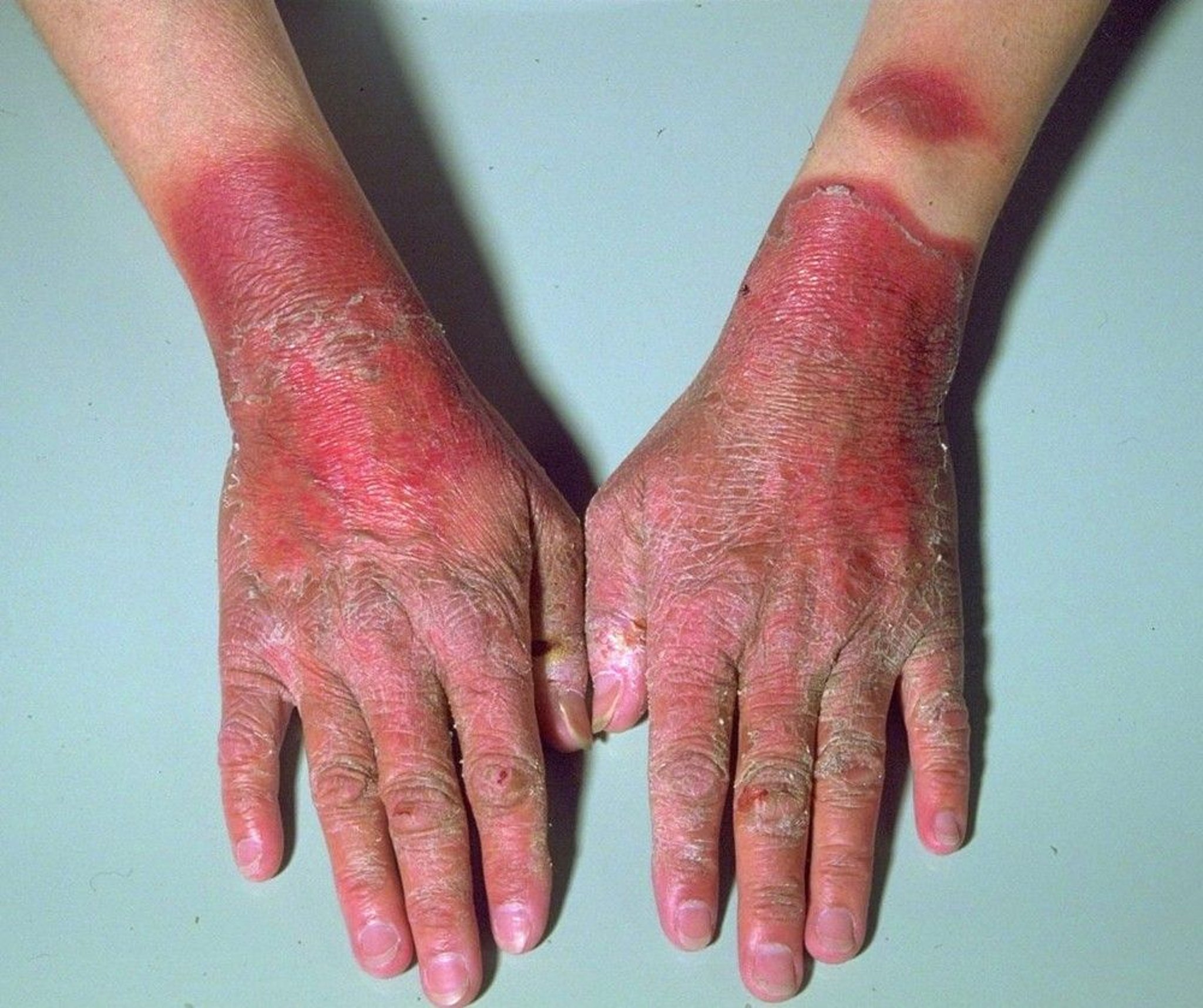 Rash on the Hands Due to Pellagra