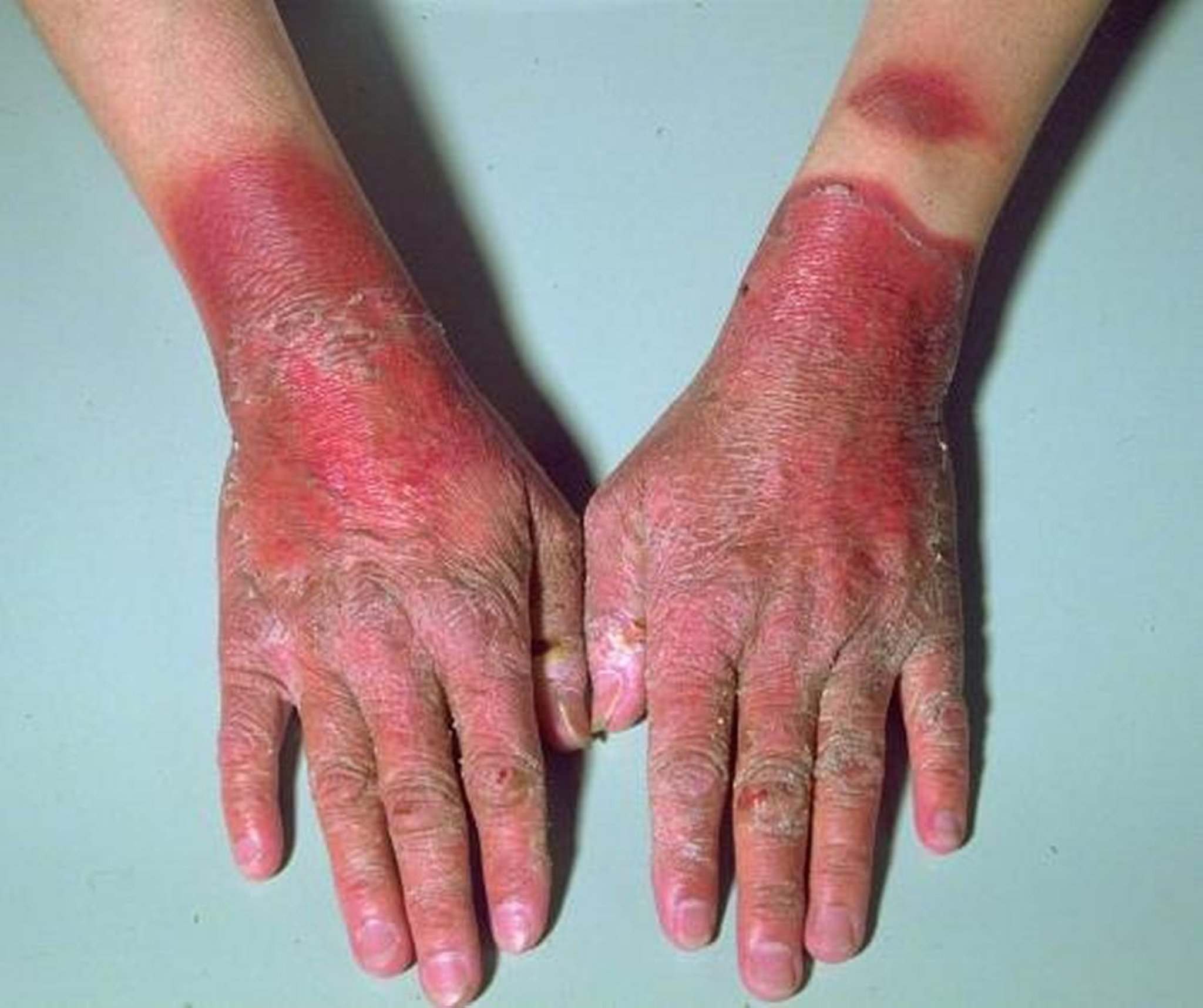 Éruption cutanée sur les mains due à la pellagre