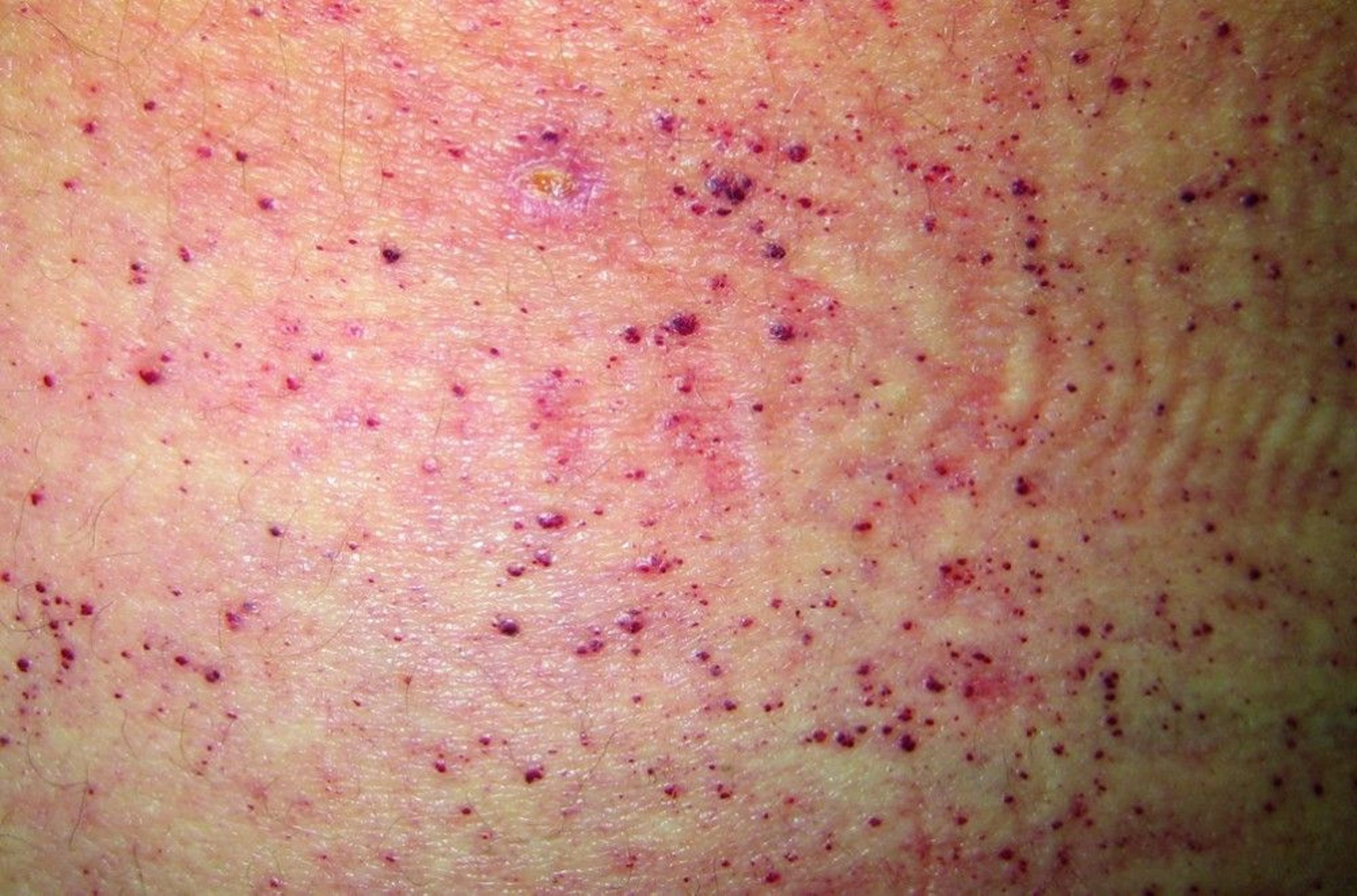 Angiokeratomas in Fabry Disease