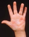 Superficial Burns
