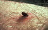 Tick Biting a Person