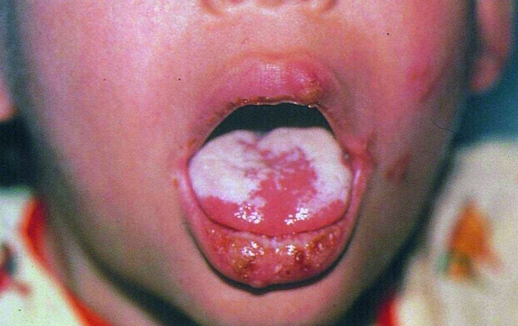 Candidiasis de la boca (lengua)