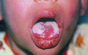 Candidiasis de la boca (lengua)