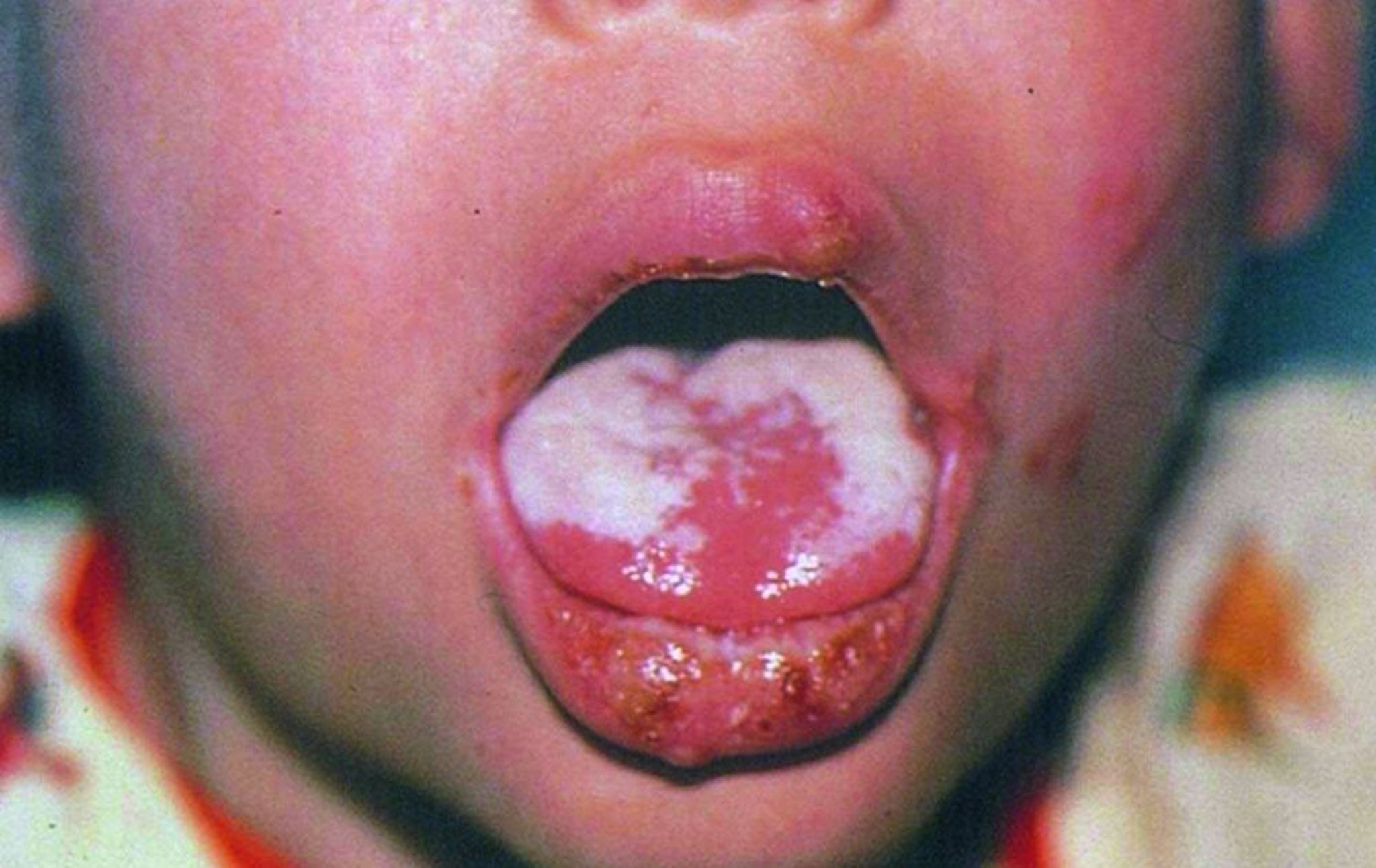 鵞口瘡（舌）