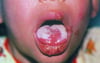 Candidíase oral (língua)