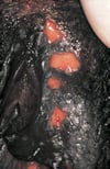 Genital Herpes Causing Open Sores