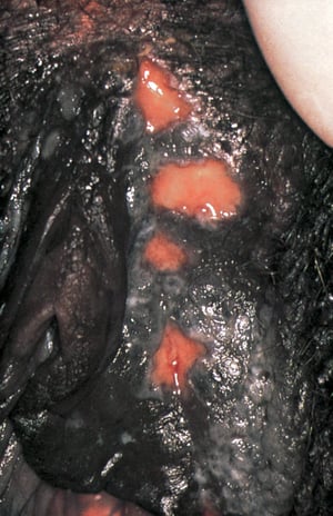 Herpes genital que causa úlceras