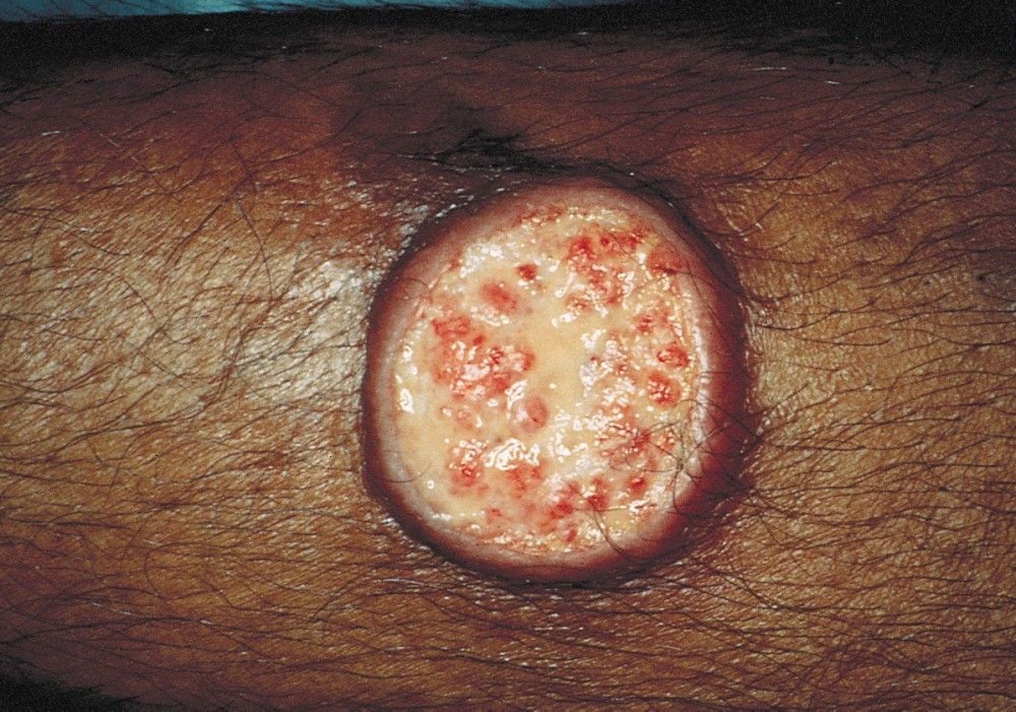 Cutaneous Leishmaniasis