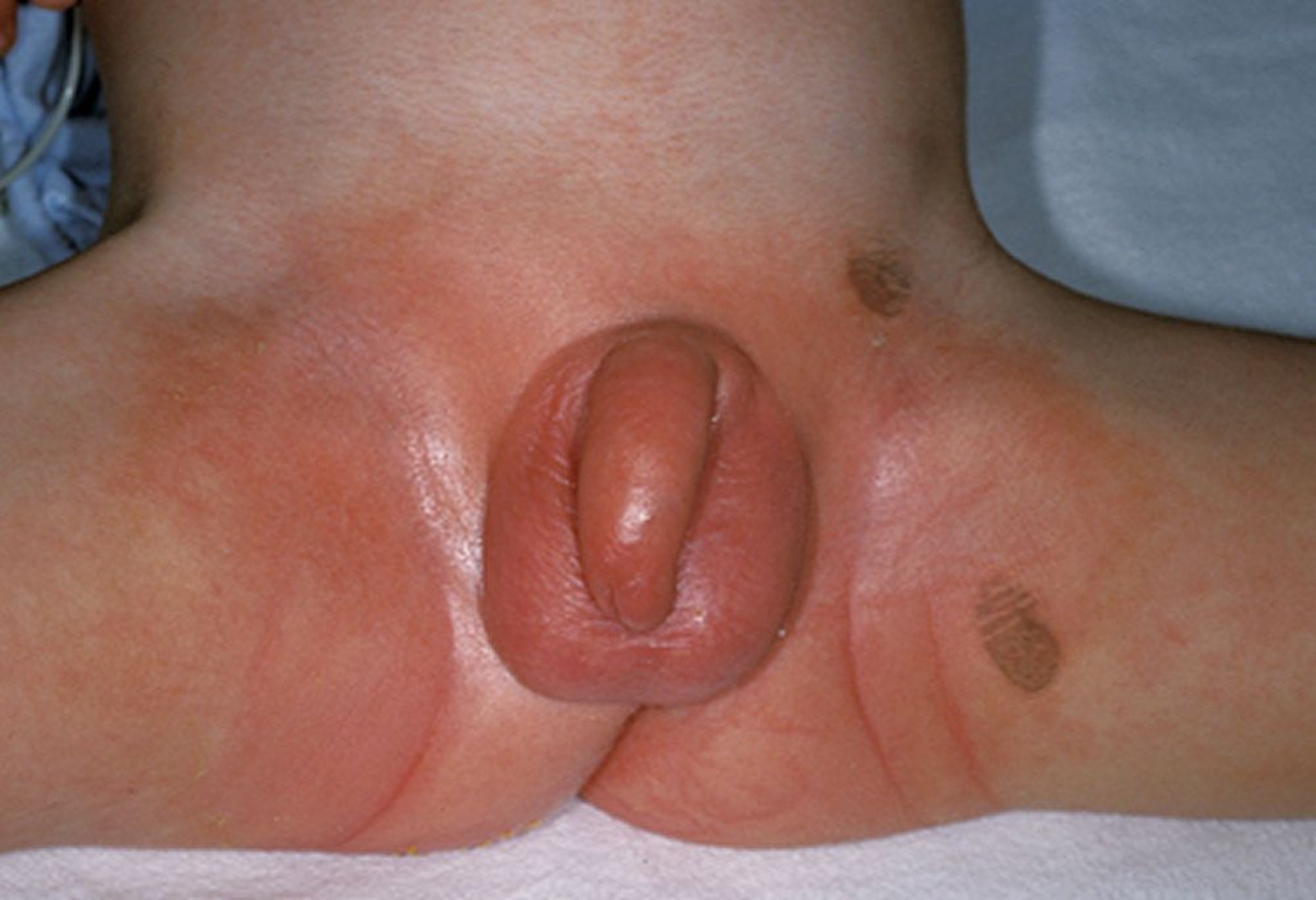 Ausschlag beim Kawasaki-Syndrom