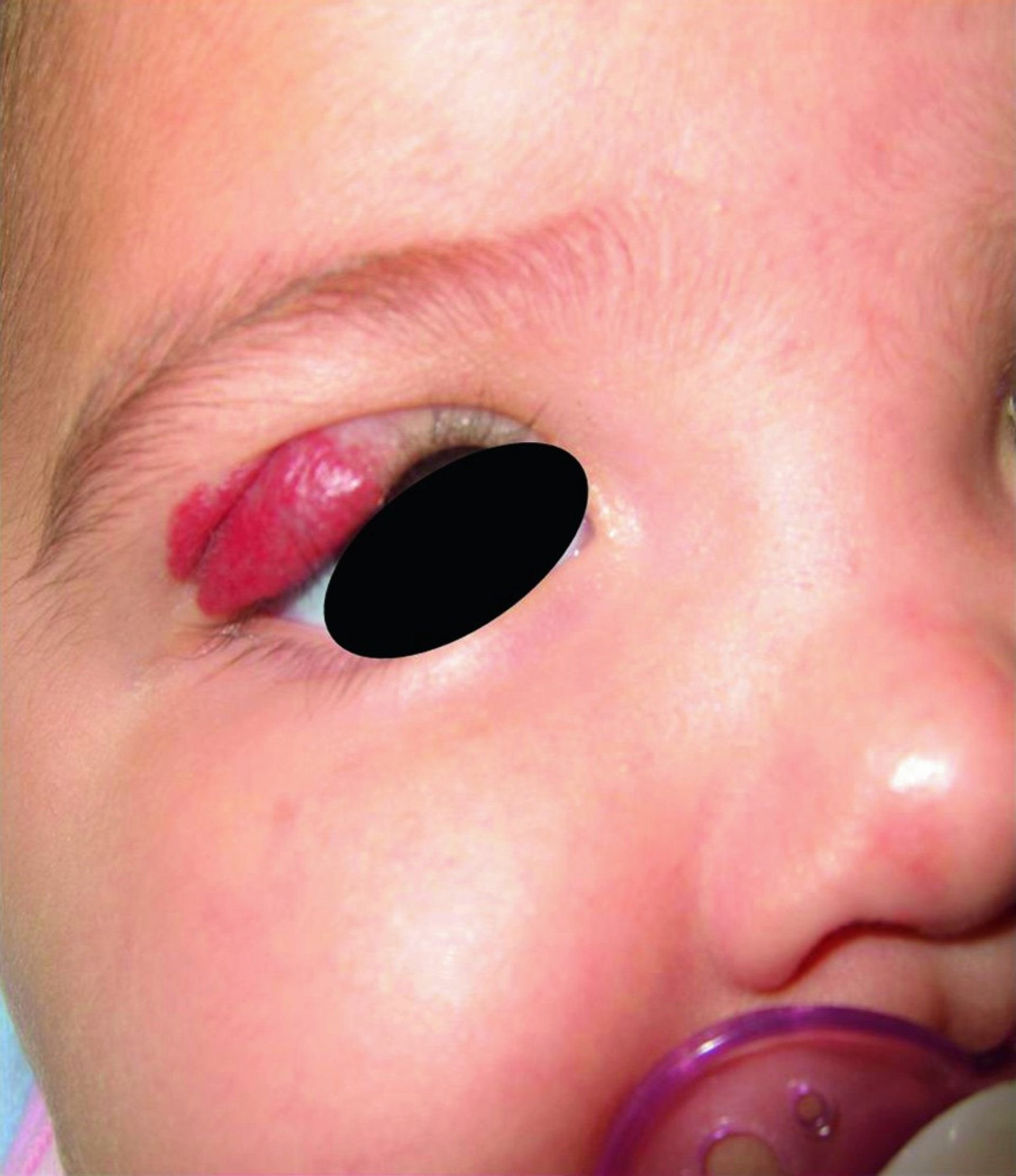 Infantile Hemangioma (Eyelid)