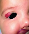 Hemangioma infantil (párpado)