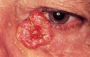 Carcinome basocellulaire nodulaire