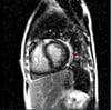 Syndrome de Raynaud