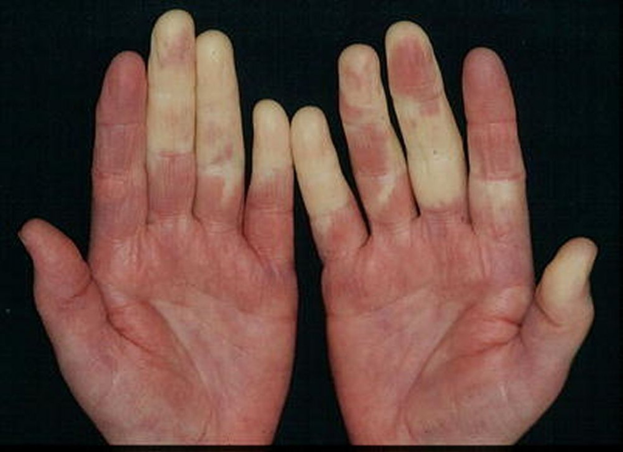 Síndrome de Raynaud