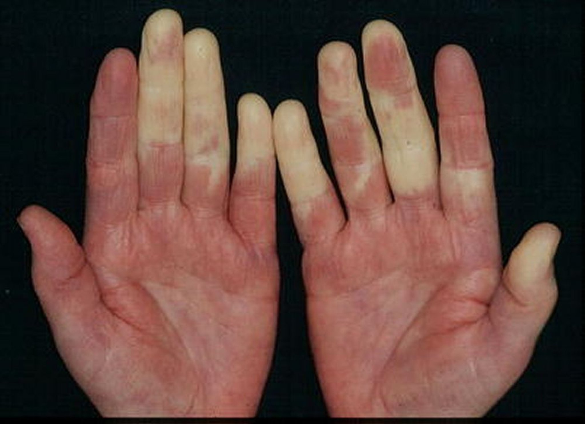 Syndrome de Raynaud avec pâleur