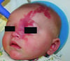 Port-Wine Stain on the Face