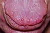 Mucosal Neuroma