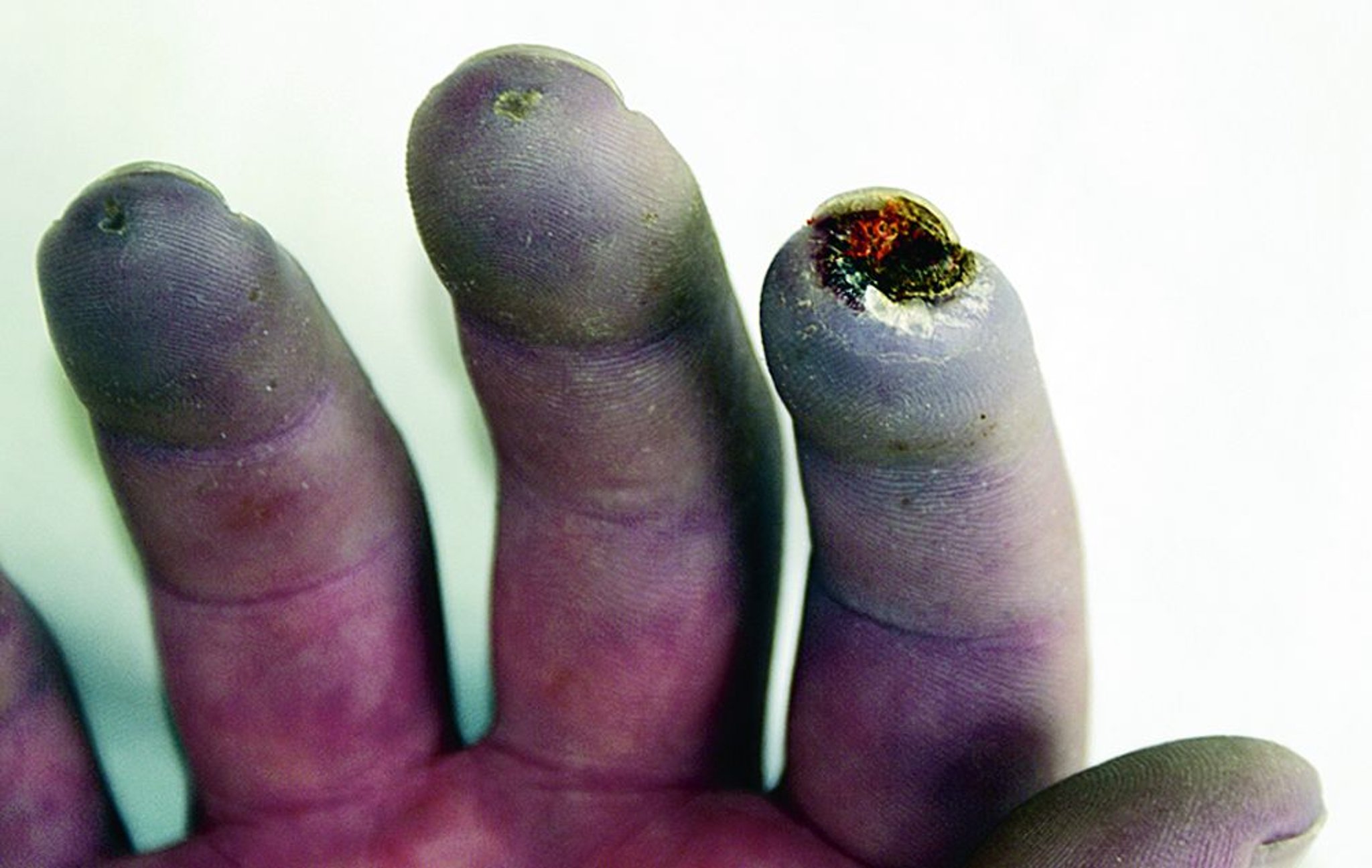 متلازمة رينو مترافقة مع قرحات على الأصابع