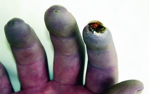 Raynaud-Syndrom mit wunden Stellen an den Fingern