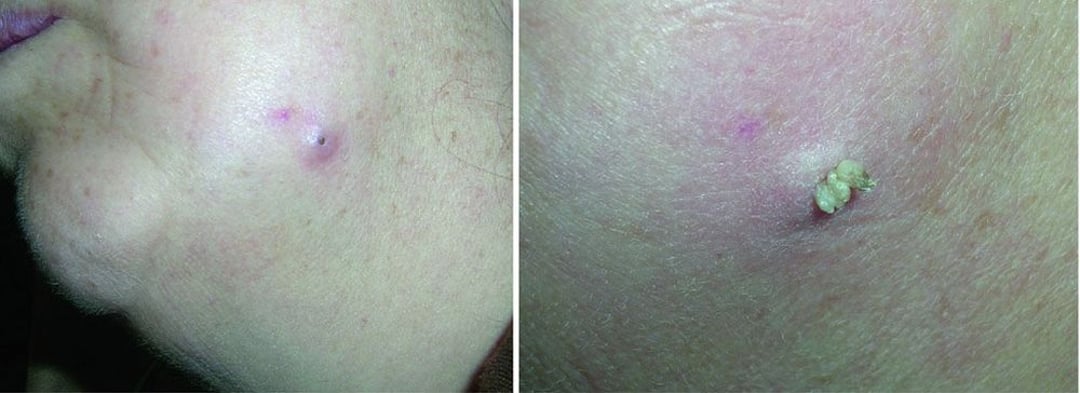 皮膚嚢腫 - 皮膚嚢腫 - MSDマニュアル家庭版