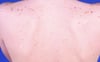 Lentiginose