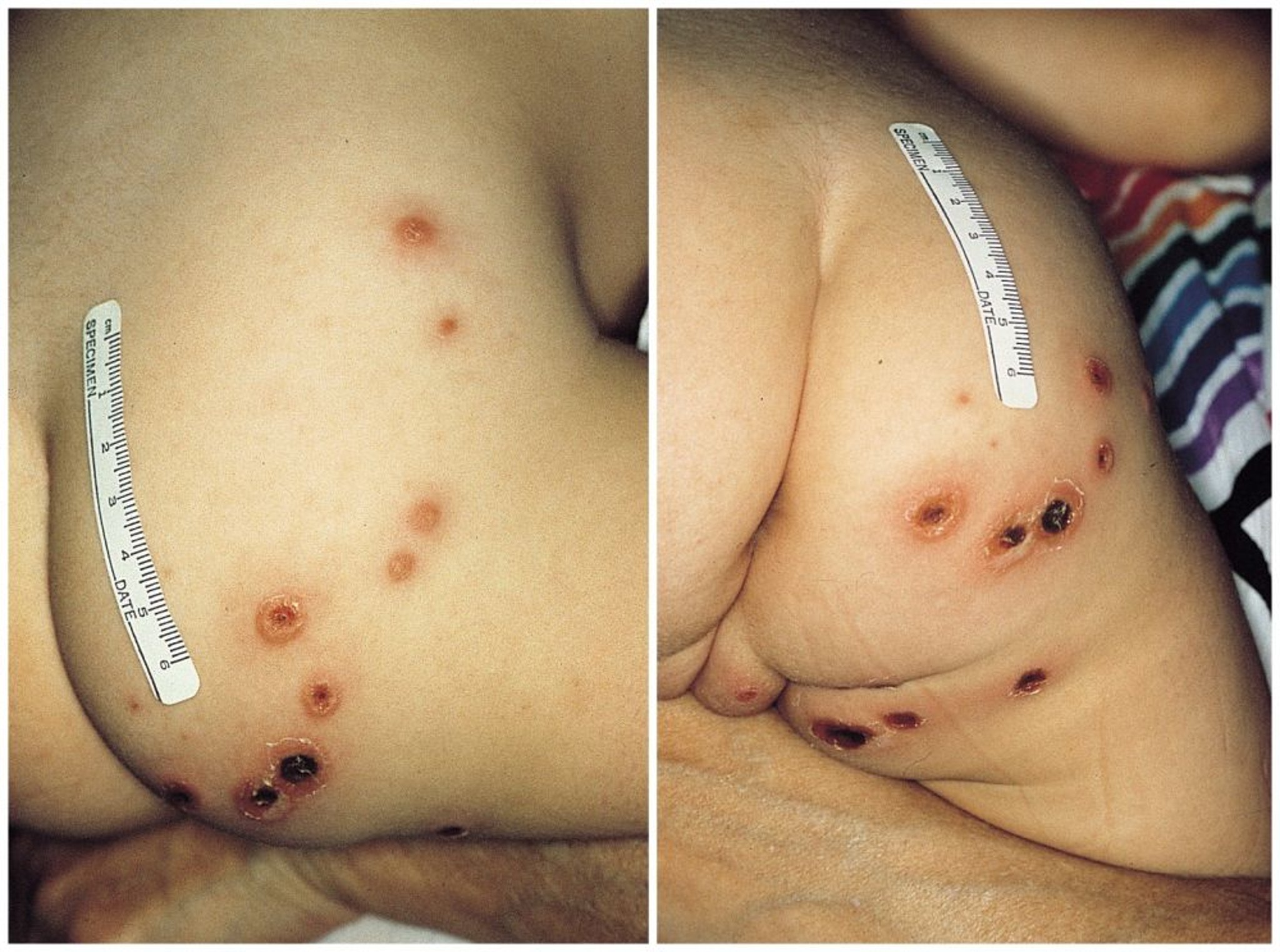 الإكثيمة ecthyma