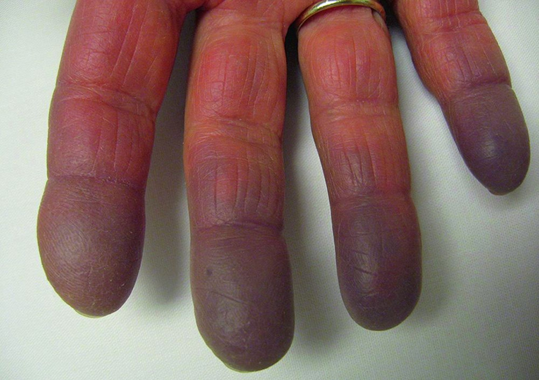 Síndrome de Raynaud con cianosis