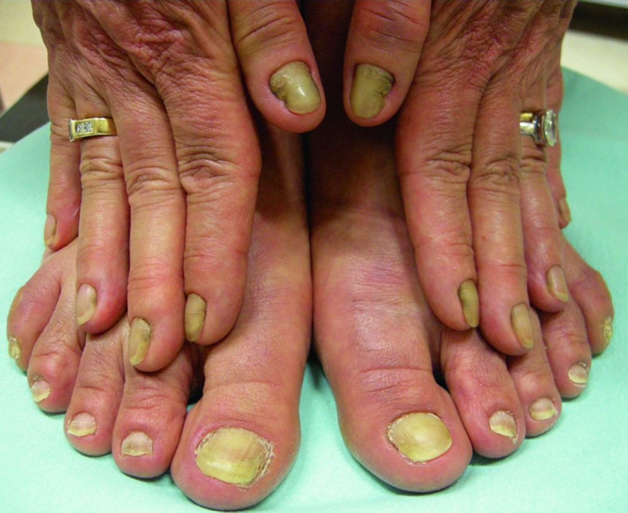 Síndrome de las uñas amarillas