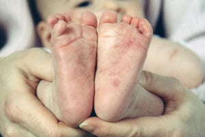 Escabiose em um bebê (Escabiose infantil)