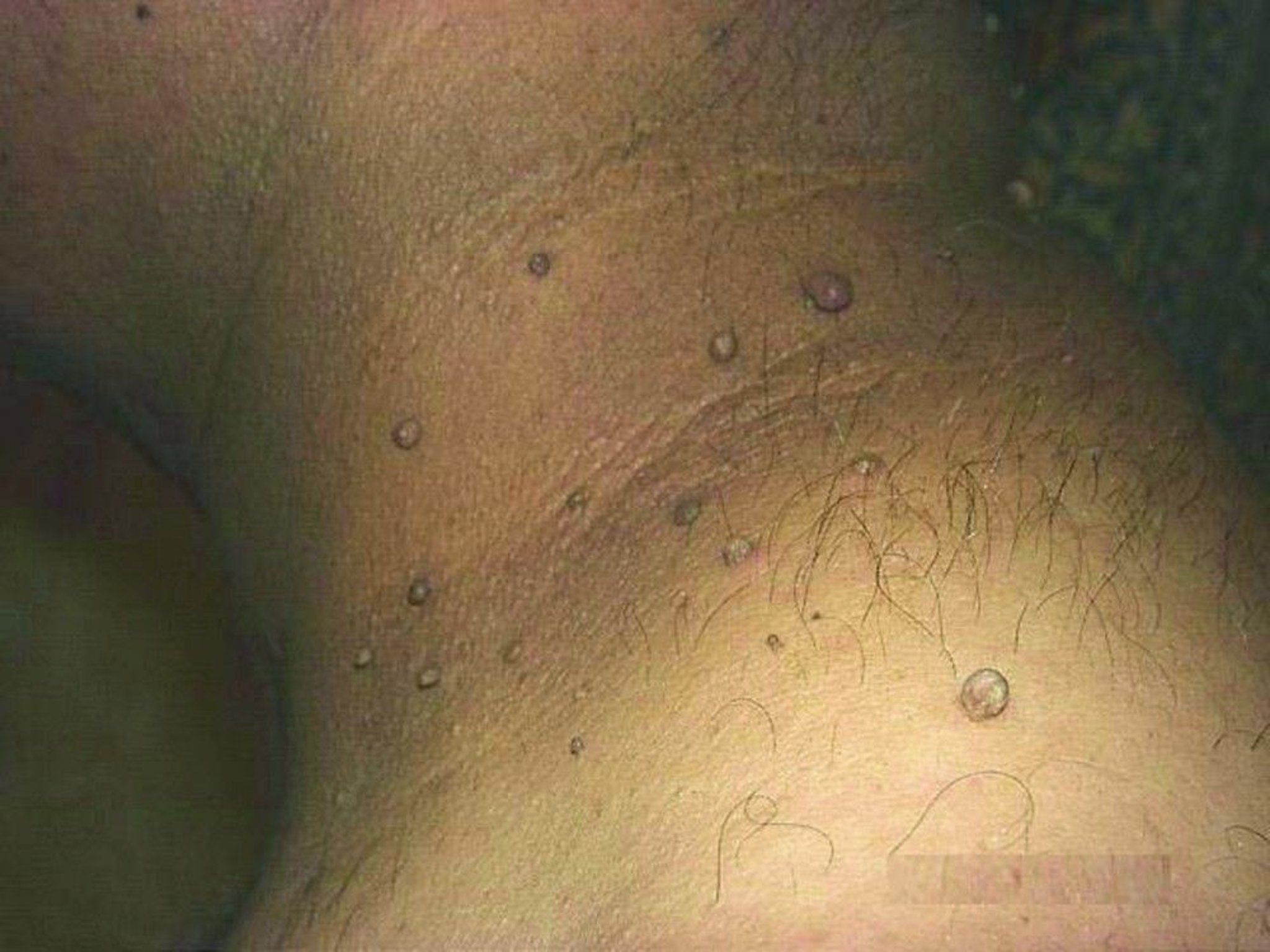 Skin Tags