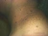 Acrocordones