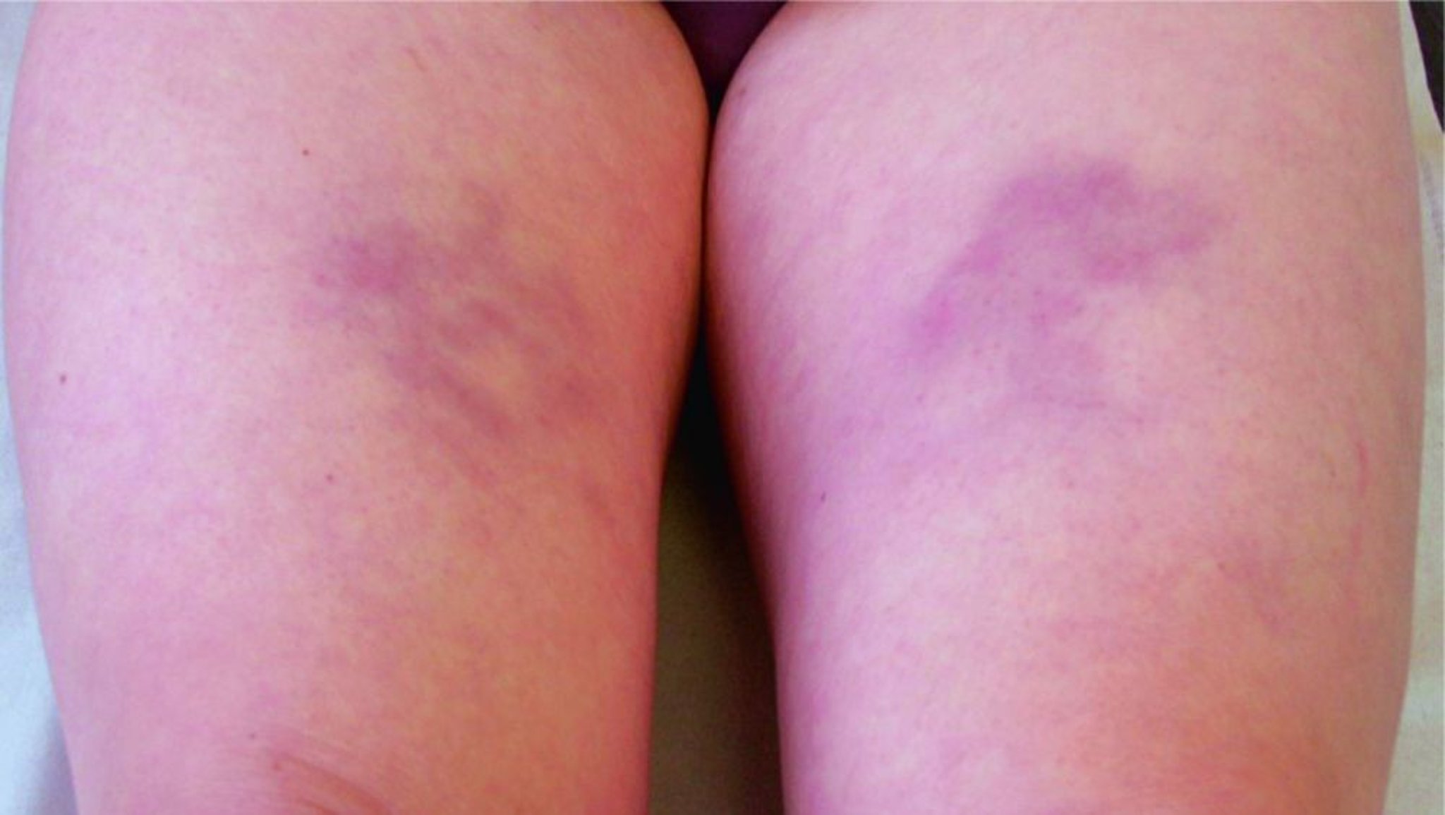 पेनिकुलाइटिस