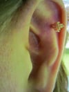 Filiform Warts