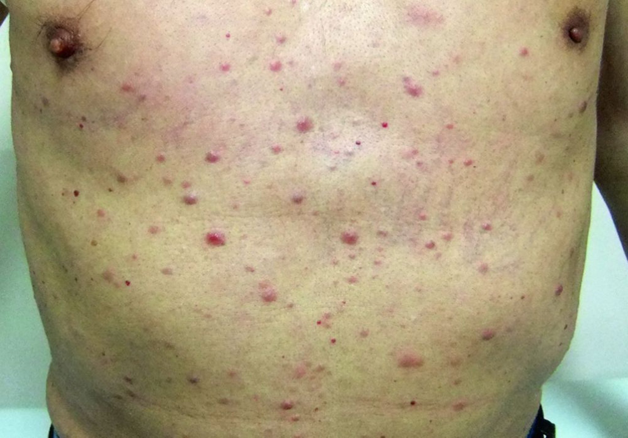 ابيضاض الدم ابيضاض الدم leukemia cutis