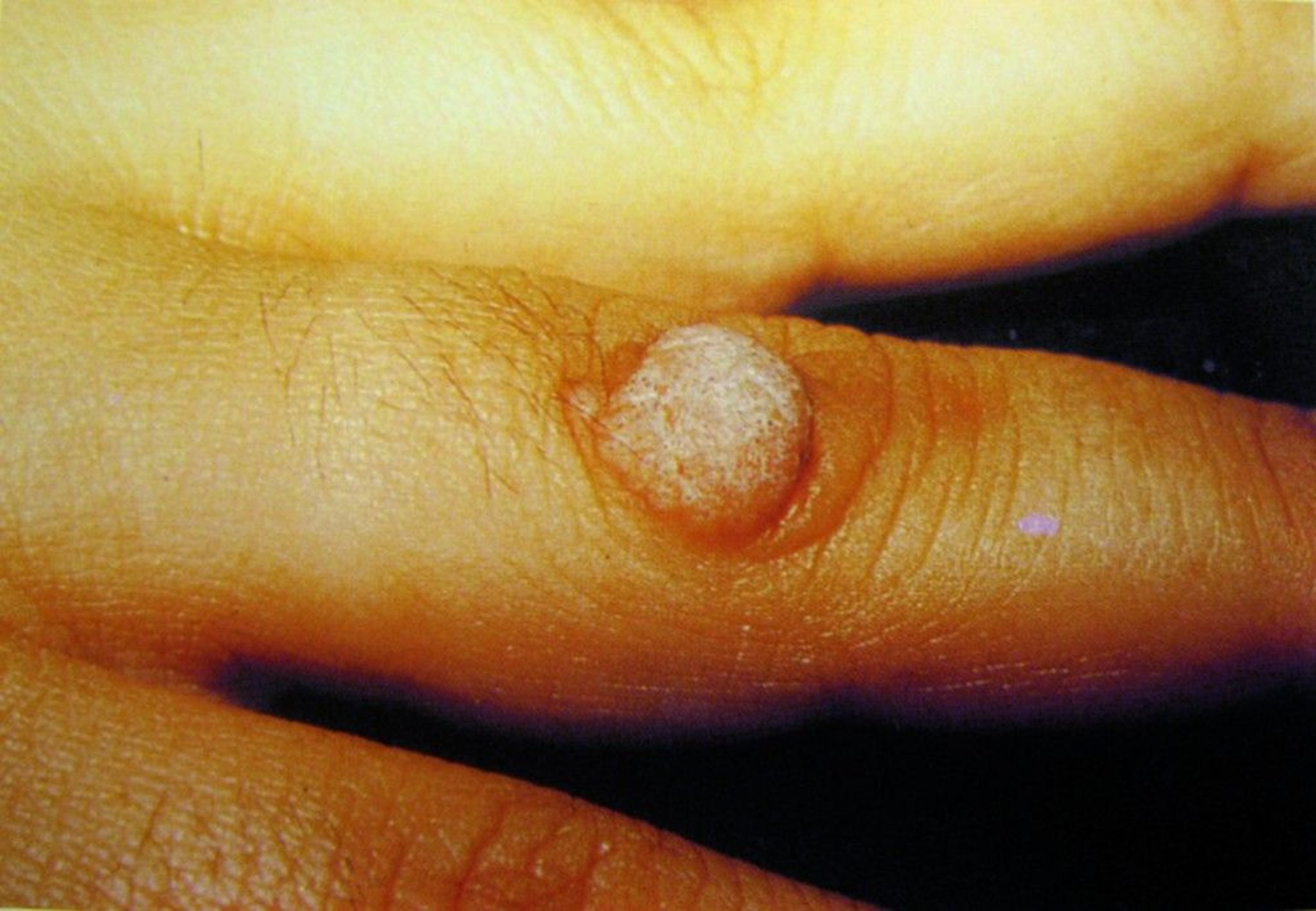 Common Wart