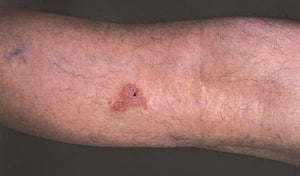 Carcinoma de células escamosas (braço)