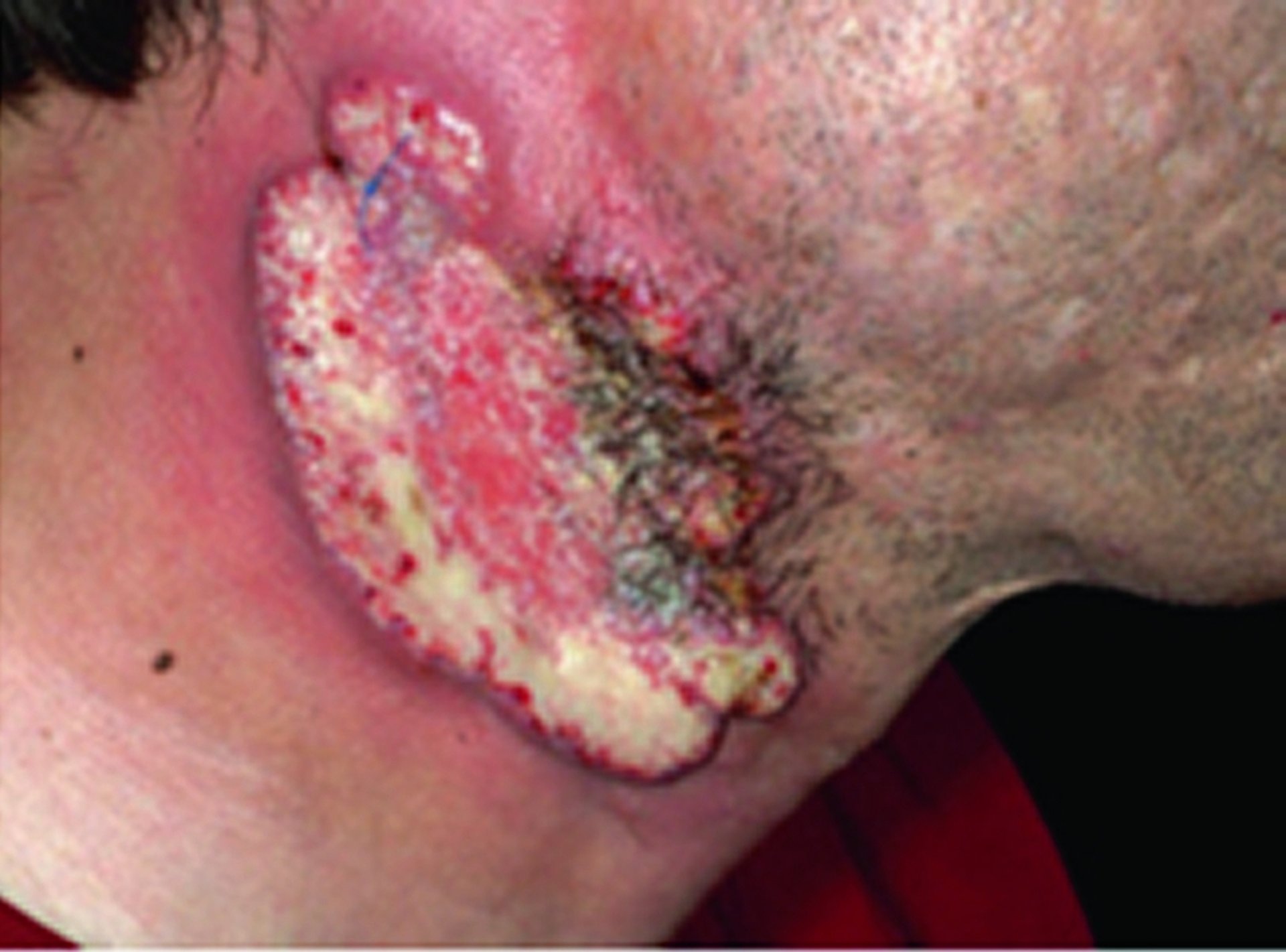Sindrome PAPA (artrite piogenica, pioderma gangrenoso e acne)