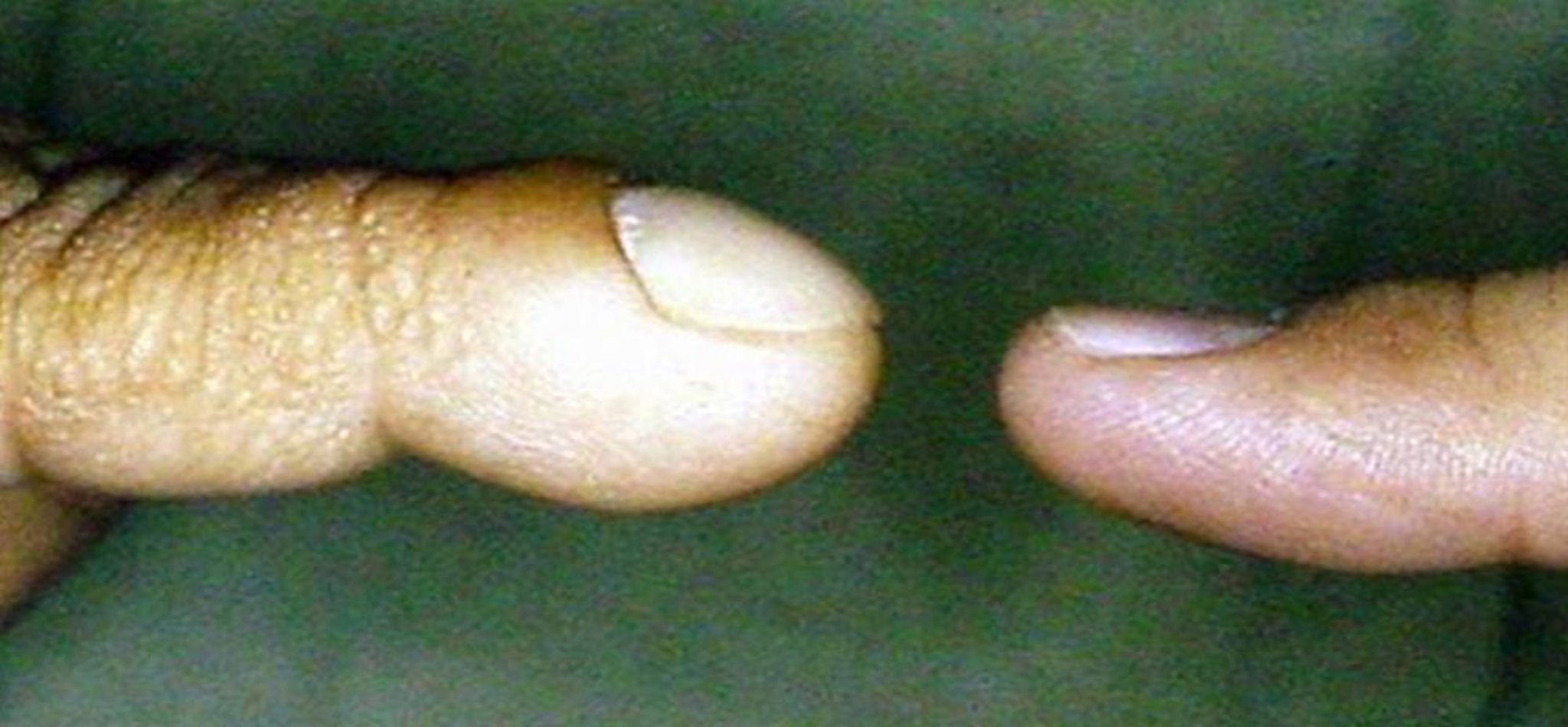 Dedos en palillo de tambor