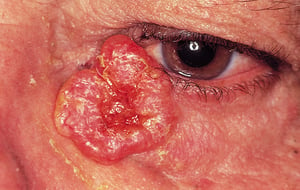 Nodular Basal Cell Carcinoma