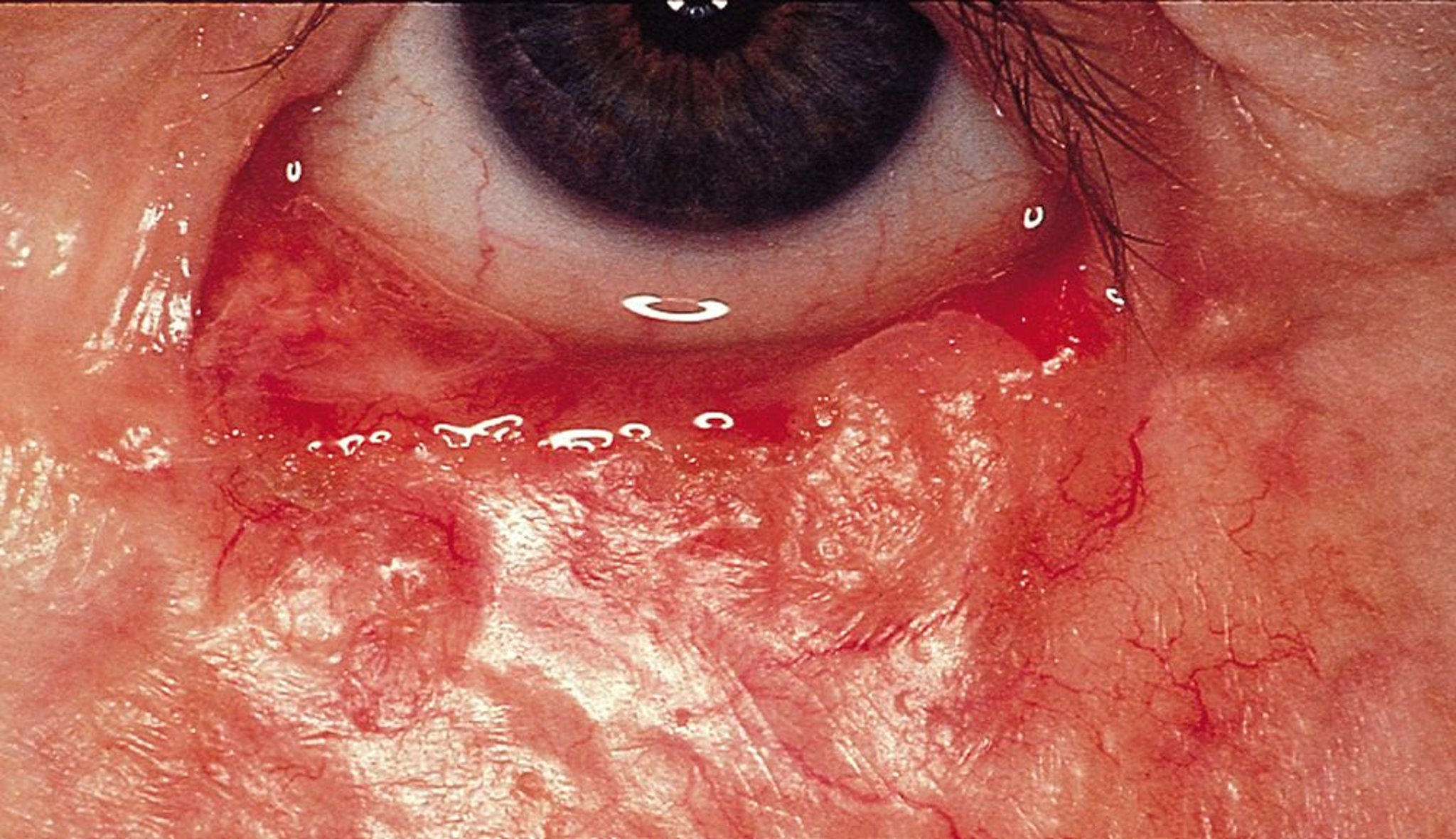 Carcinoma basocellulare morfeiforme