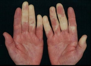 Sindrom Raynaud dengan Pallor