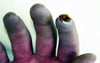 Ugonjwa wa Raynaud Unaoambatana na Vidonda kwenye Vidole