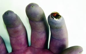 Ugonjwa wa Raynaud Unaoambatana na Vidonda kwenye Vidole