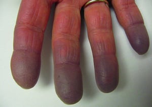 Ugonjwa wa Raynaud Unaoambatana na Kugeuka Buluu